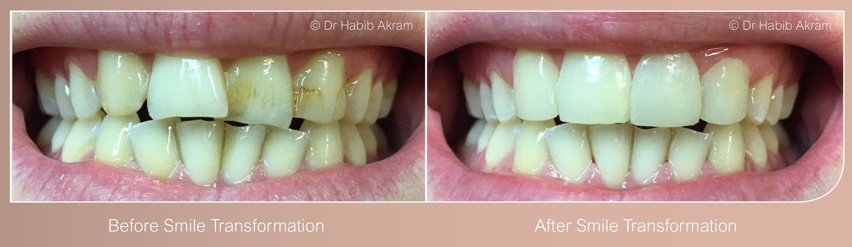 Cosmetic Dentistry Leicester Smile Makeover Wigston